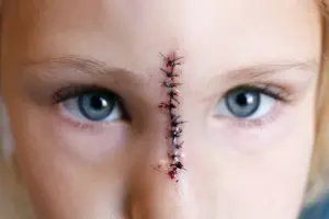 A girl with stitches on her face.